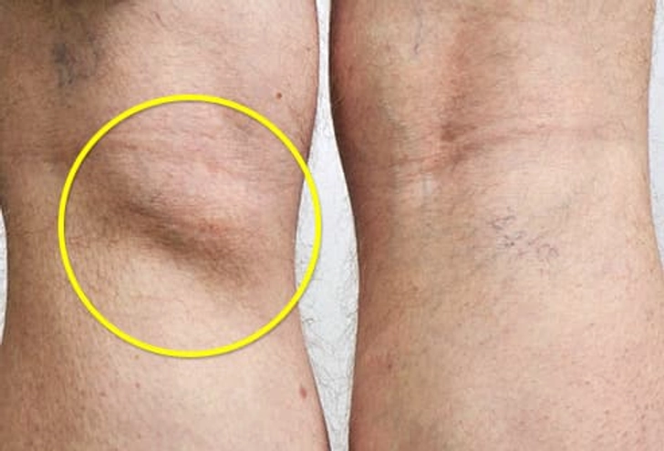 Baker's Cyst (Popliteal Cyst) Baker's Cyst (Popliteal Cyst)