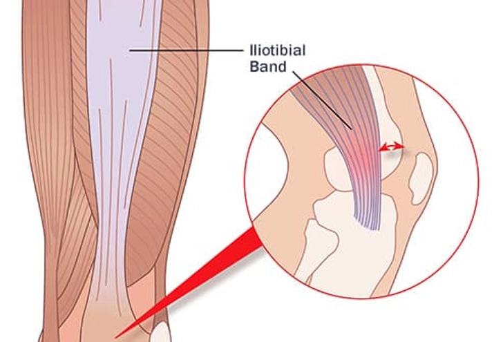 Iliotibial Band Syndrome Iliotibial Band Syndrome