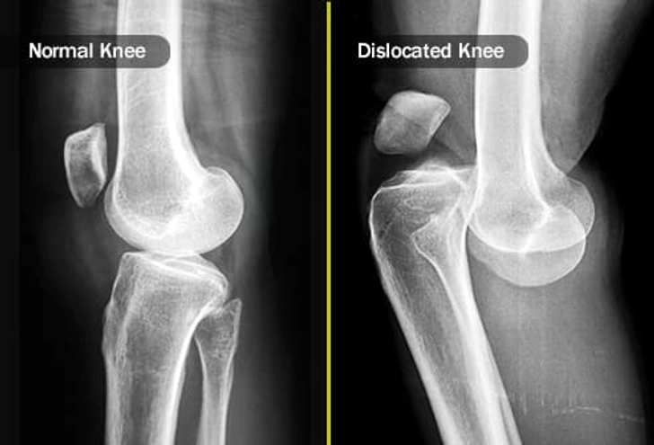 Dislocations and Fractures Dislocations and Fractures