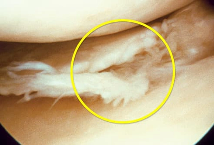 Torn Meniscus