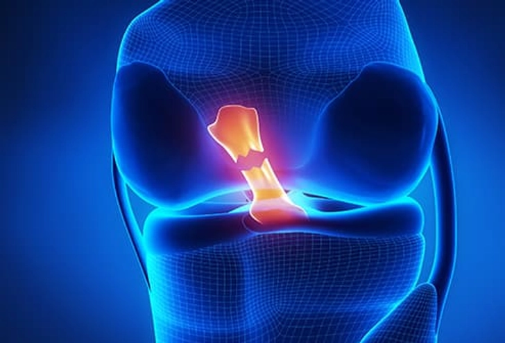 Torn Anterior Cruciate Ligament