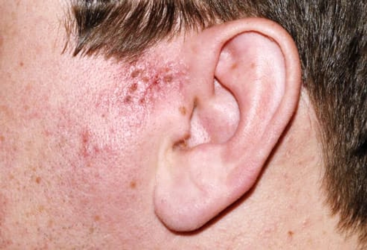 Ramsay Hunt Syndrome