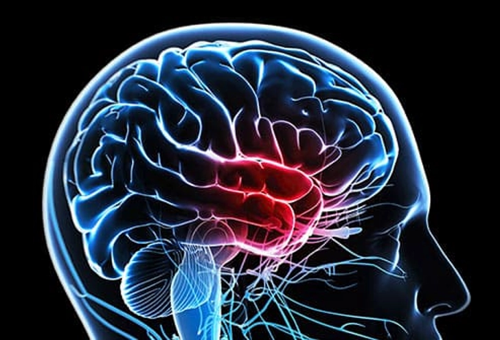 Vestibular Migraine Vestibular Migraine
