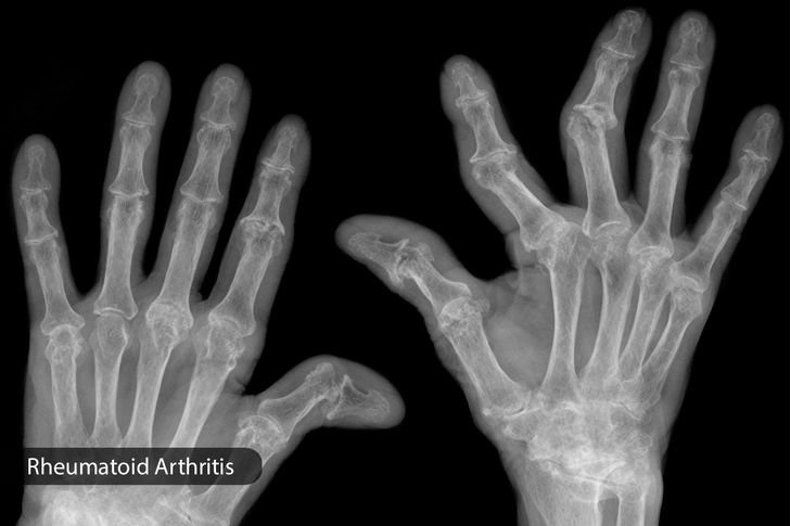 Autoimmune Disease