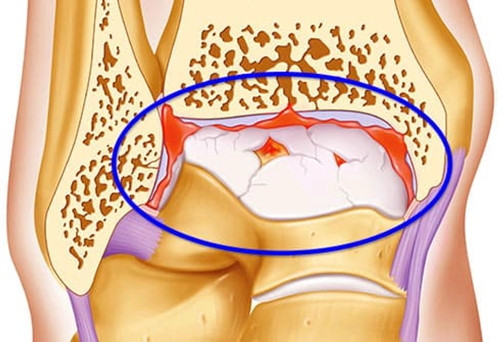 Osteoarthritis