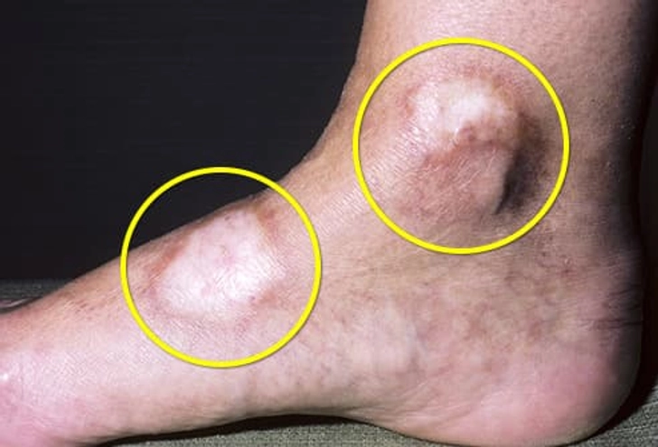 Scleroderma Scleroderma