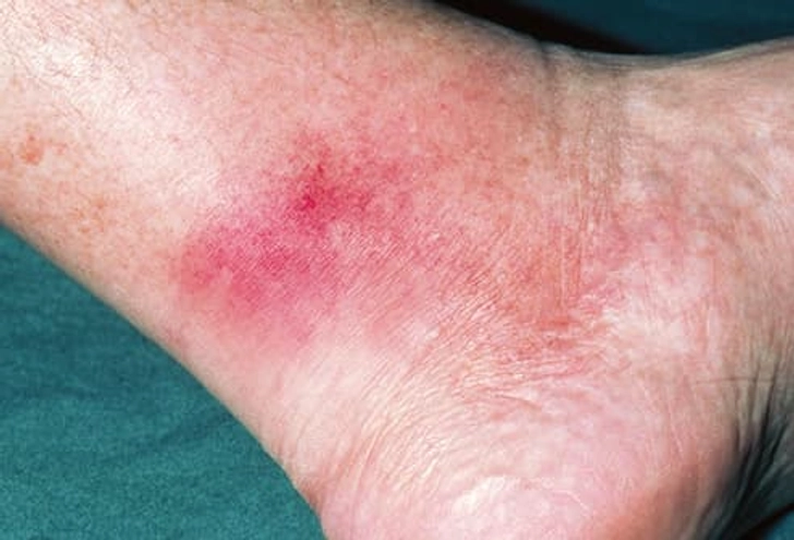 Infection Infection
