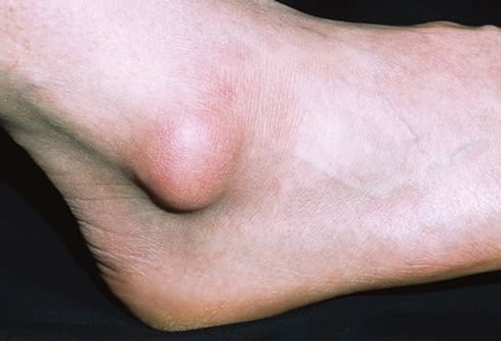 Bursitis