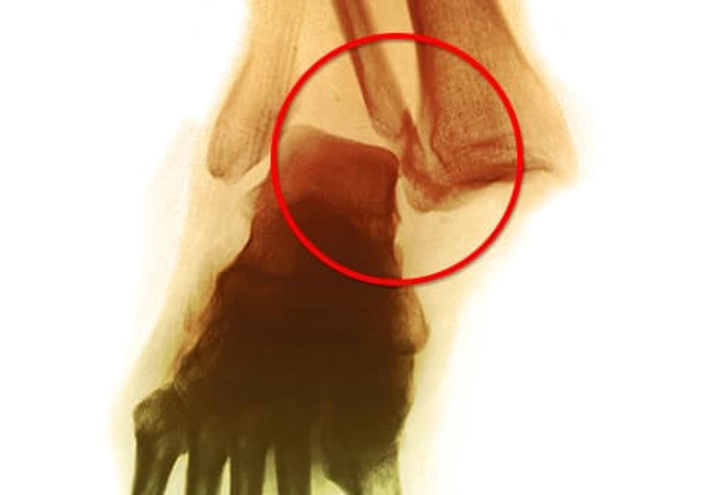 Ankle Fracture