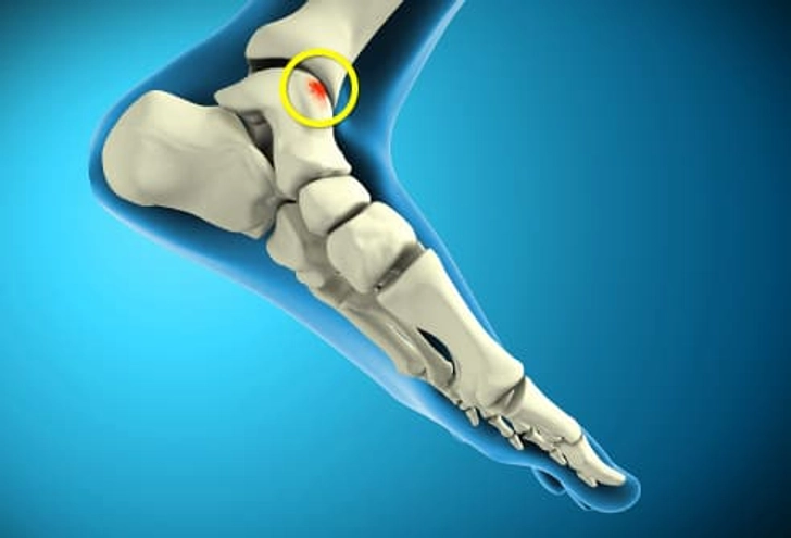 Osteochondral Lesions of the Talus (OLT)