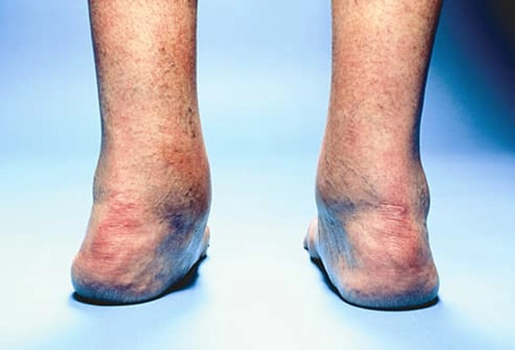 Rheumatoid Arthritis Rheumatoid Arthritis