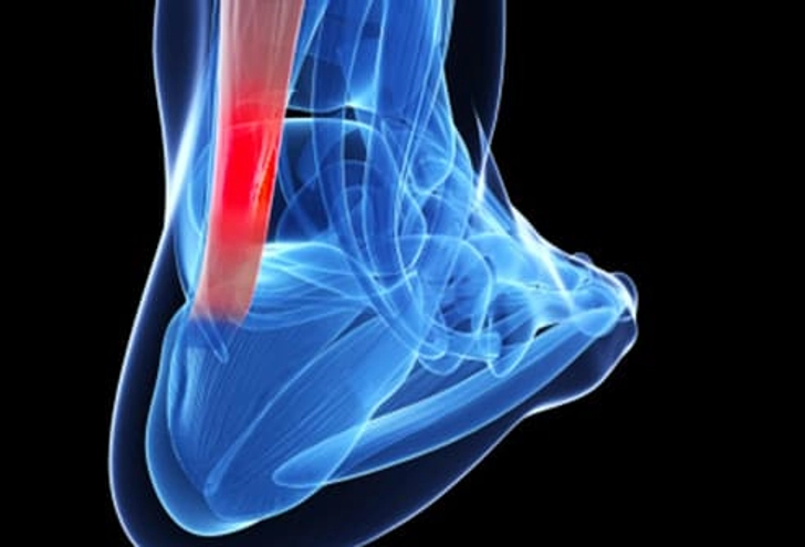 Achilles Tendinitis Achilles Tendinitis