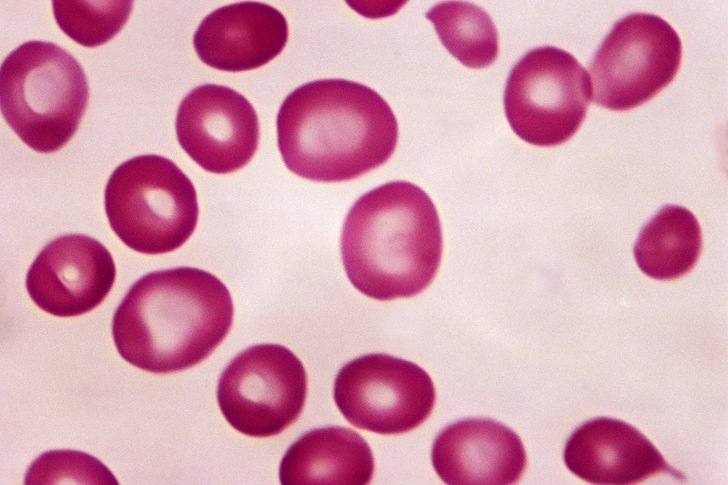Anemia Anemia