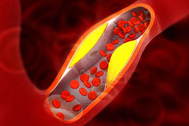 Peripheral Artery Disease (PAD)