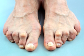 Arthritis