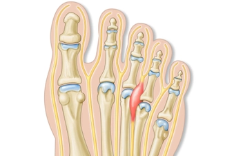 Morton’s Neuroma