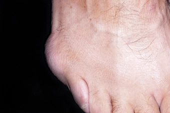 Bursitis