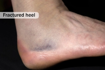 Broken Bone