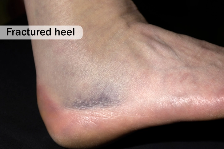 Broken Bone