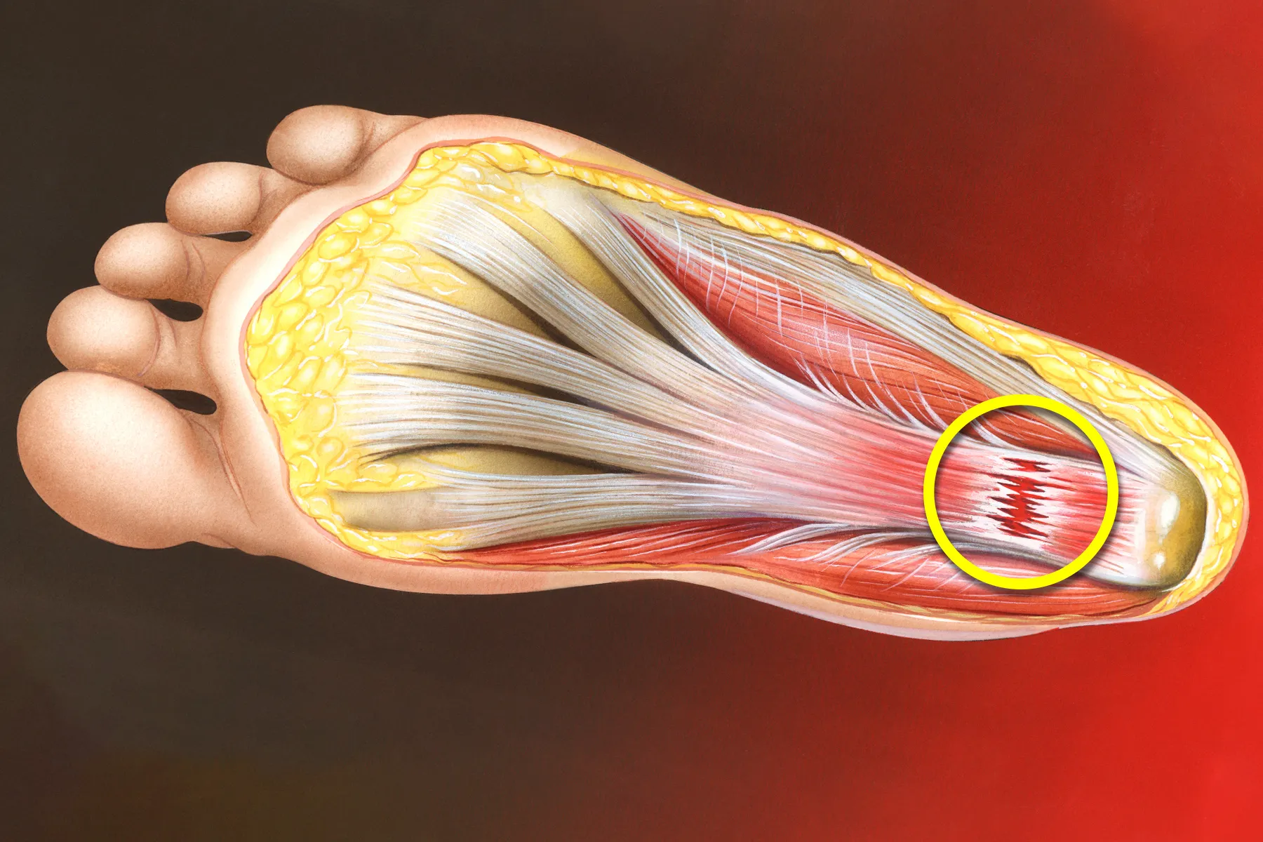 illustration of plantar fasciitis