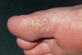 Plantar Warts