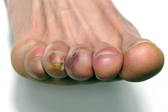 Raynaud’s Phenomenon
