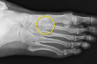Stress Fracture