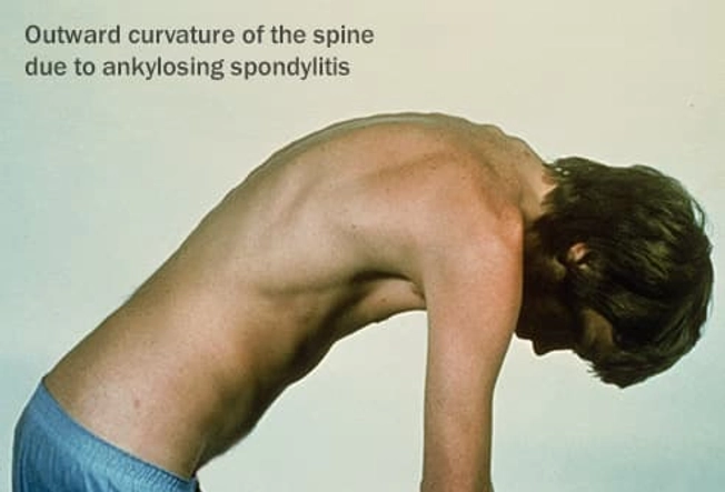 Another Type of Arthritis Another Type of Arthritis