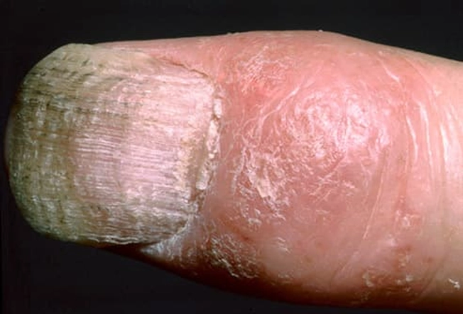 Psoriatic Arthritis (PsA) Psoriatic Arthritis (PsA)