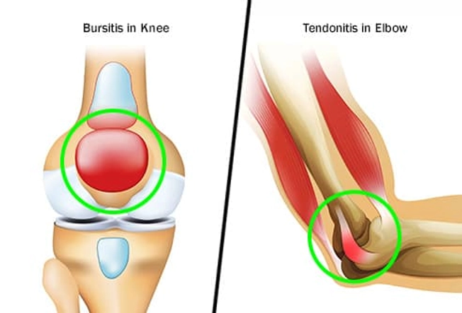 Joint Injury Joint Injury