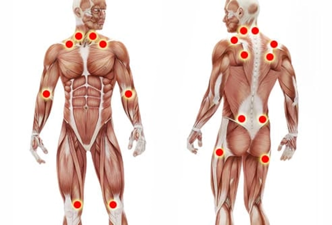 Fibromyalgia Fibromyalgia