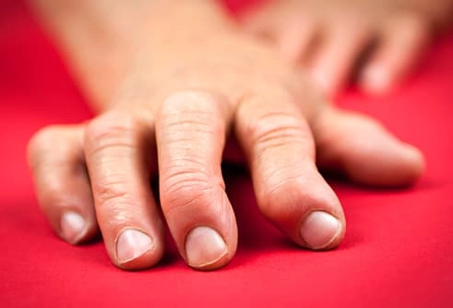 Rheumatoid Arthritis (RA) Rheumatoid Arthritis (RA)