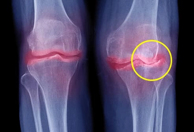 Osteoarthritis (OA)