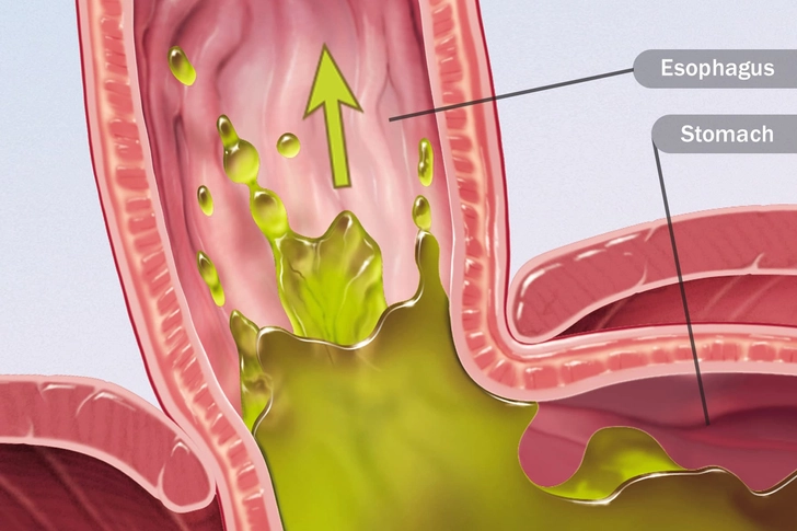 Acid Reflux