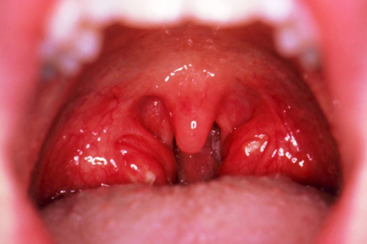 Tonsillitis
