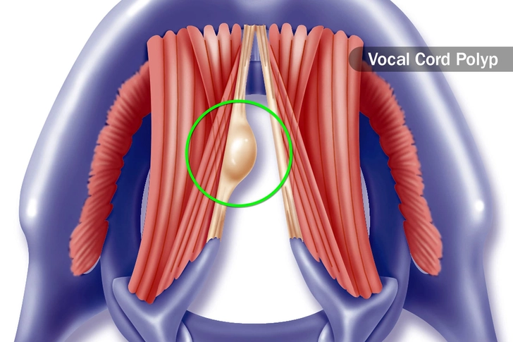 Noncancerous Bumps and Lumps Noncancerous Bumps and Lumps
