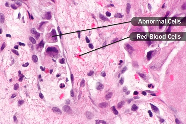 Precancerous cells Precancerous cells