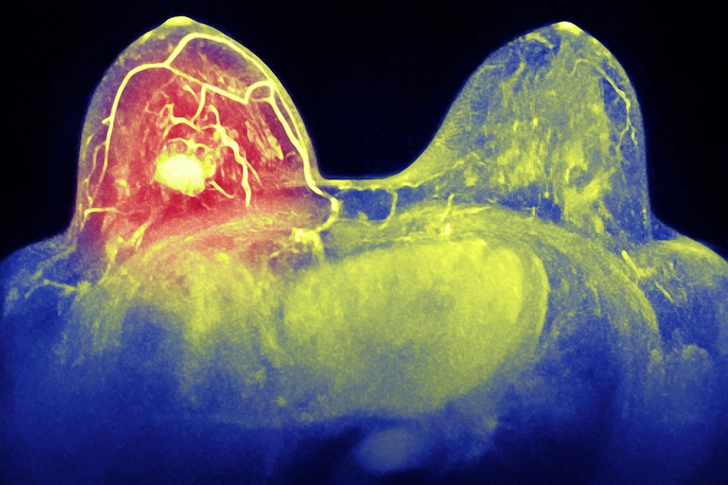 Benign Tumor