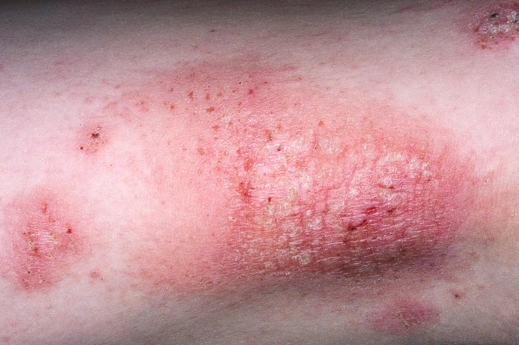 Eczema