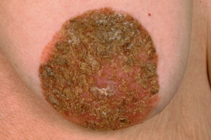 Paget's Disease