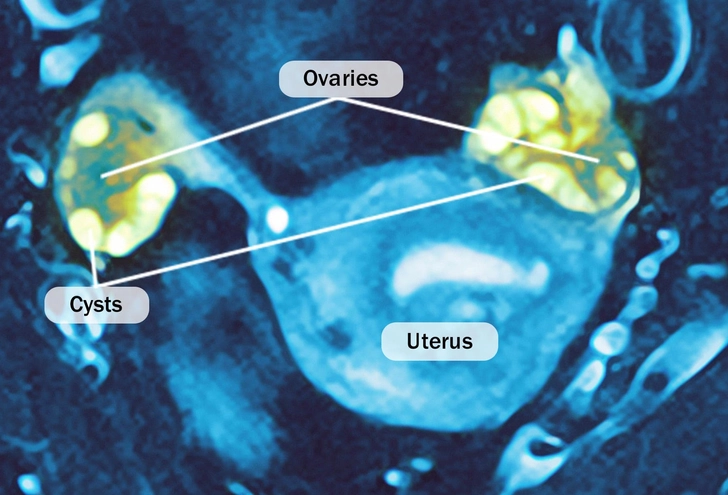 Polycystic Ovary Syndrome (PCOS) Polycystic Ovary Syndrome (PCOS)