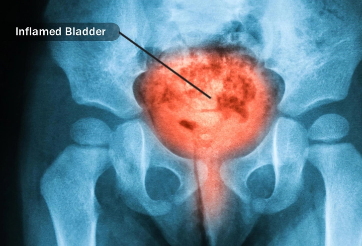 Interstitial Cystitis (IC) Interstitial Cystitis (IC)