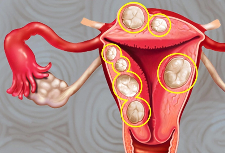 Uterine Fibroids Uterine Fibroids