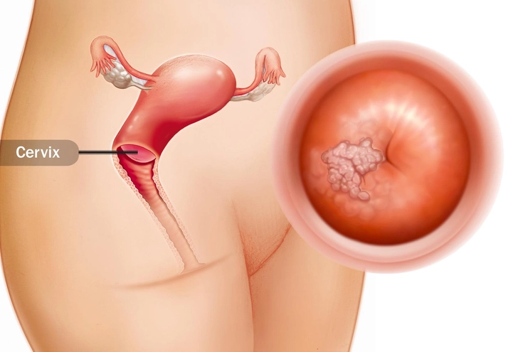 Cervical Cancer