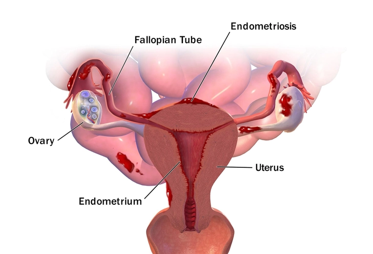 Endometriosis Endometriosis
