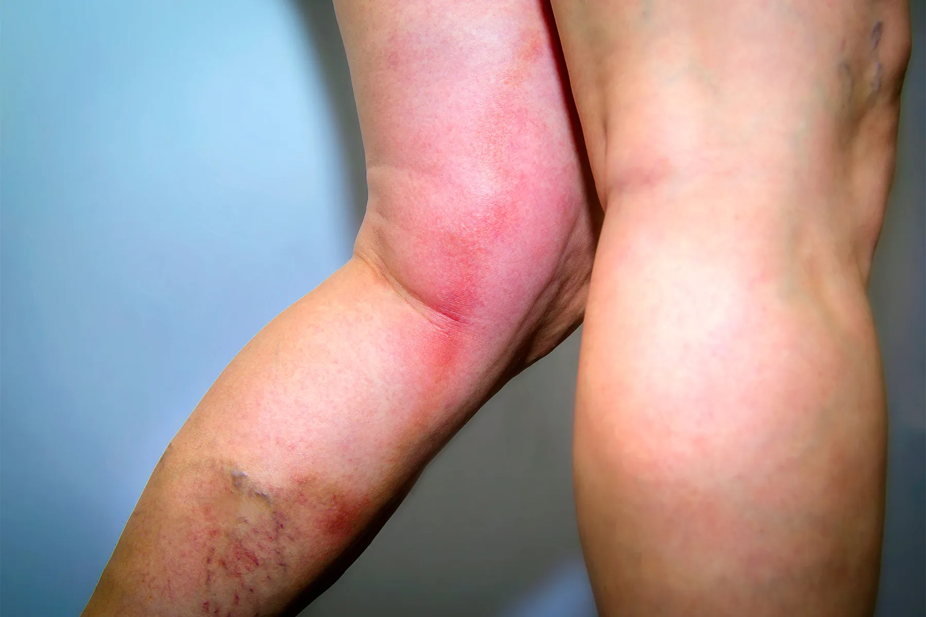 photo of deep vein thrombosis, 