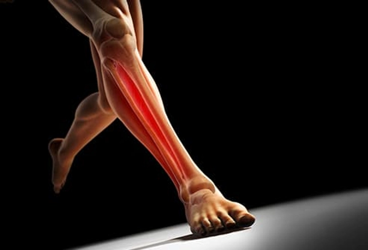 Shin Splints Shin Splints