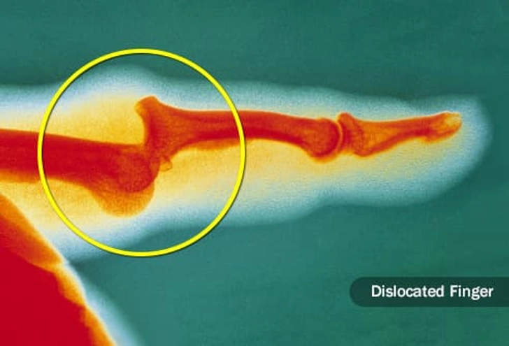Dislocation