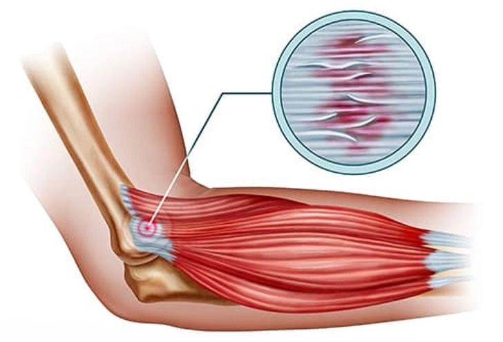 Tendinosis Tendinosis