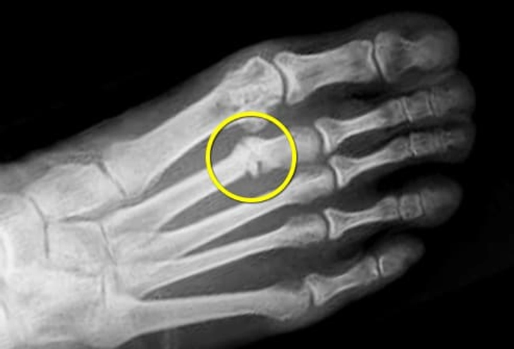 Stress Fracture Stress Fracture